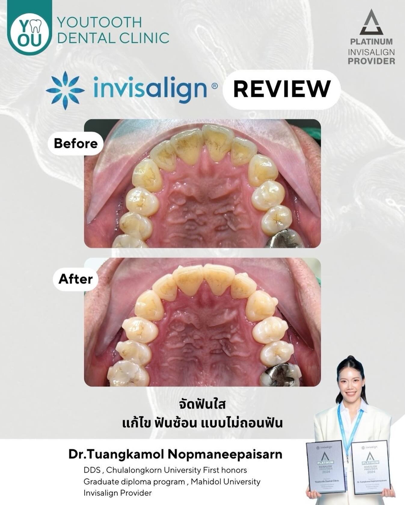 วันนี้ คุณหมอ ออยขออนุญาตมาอัพเดทความรู้งานประชุม #invisalign 1 วันนะคะ ...