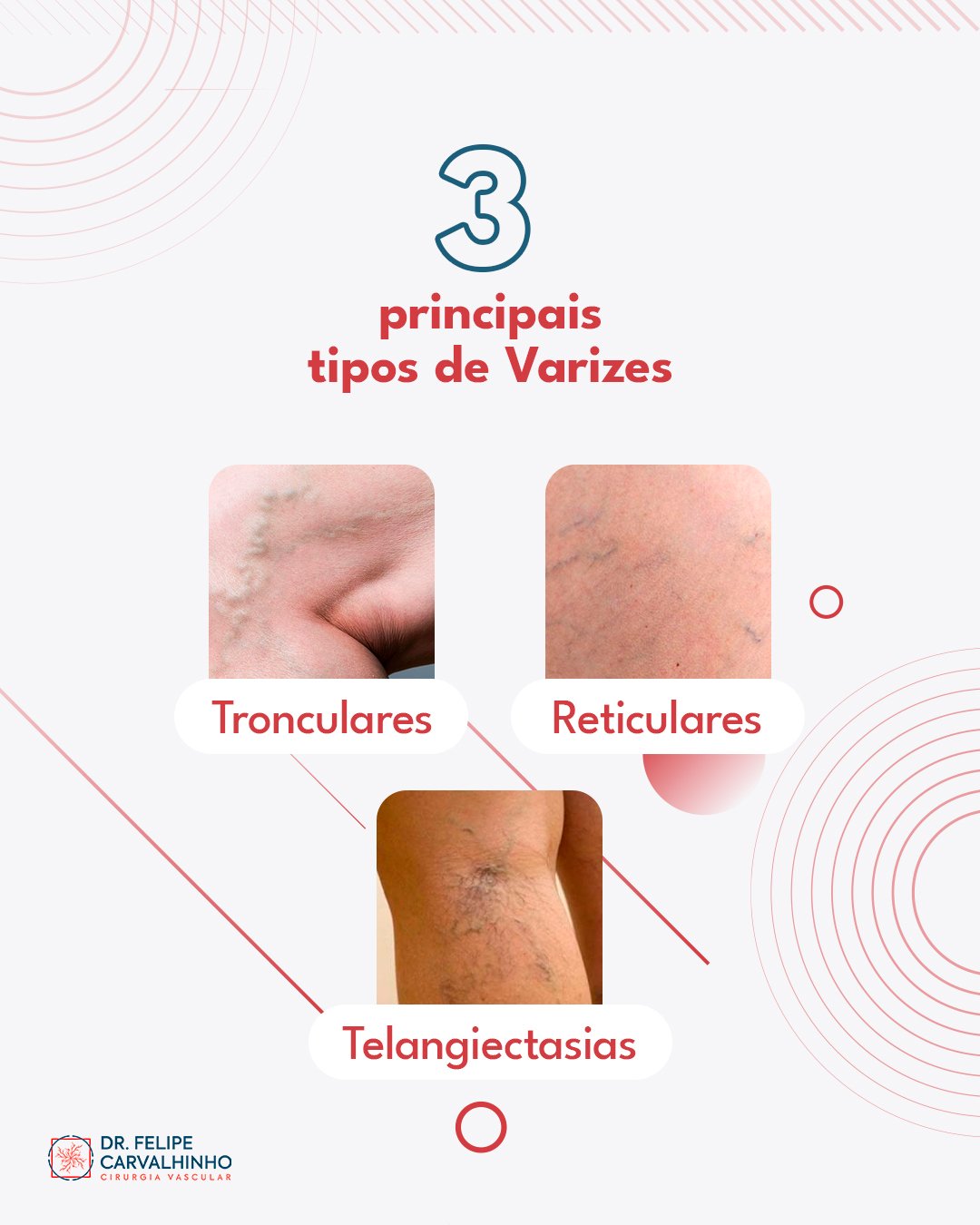 Existem diferentes tipos... - Dr. Felipe Carvalhinho Vieira