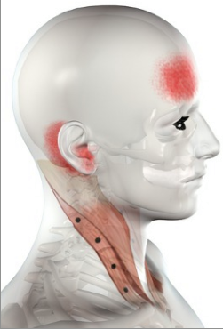 Divine Modalities - The SCM or Sternocleidomastoid causes many symptoms ...