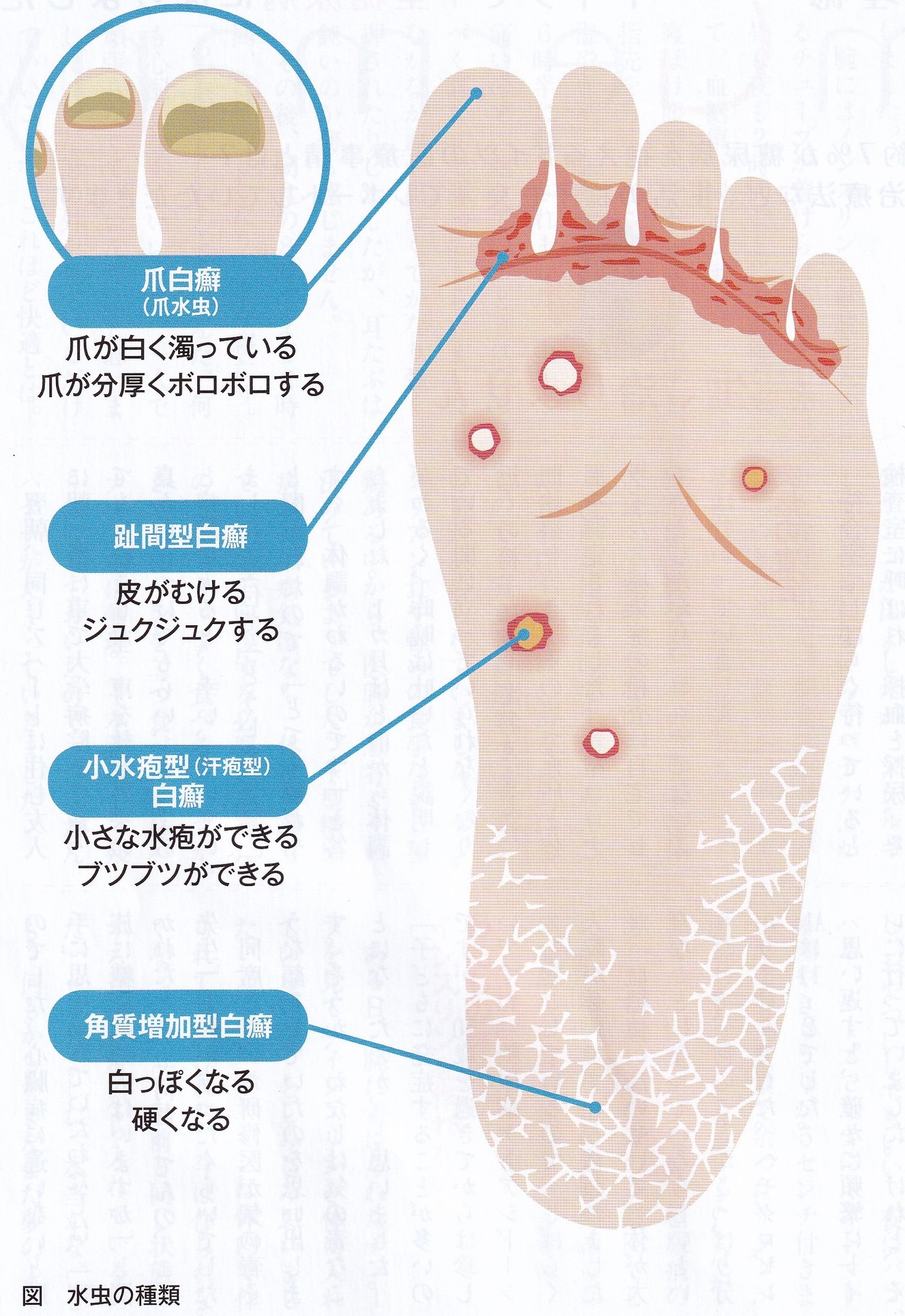 汗 疱 と 水虫 の 違い 画像