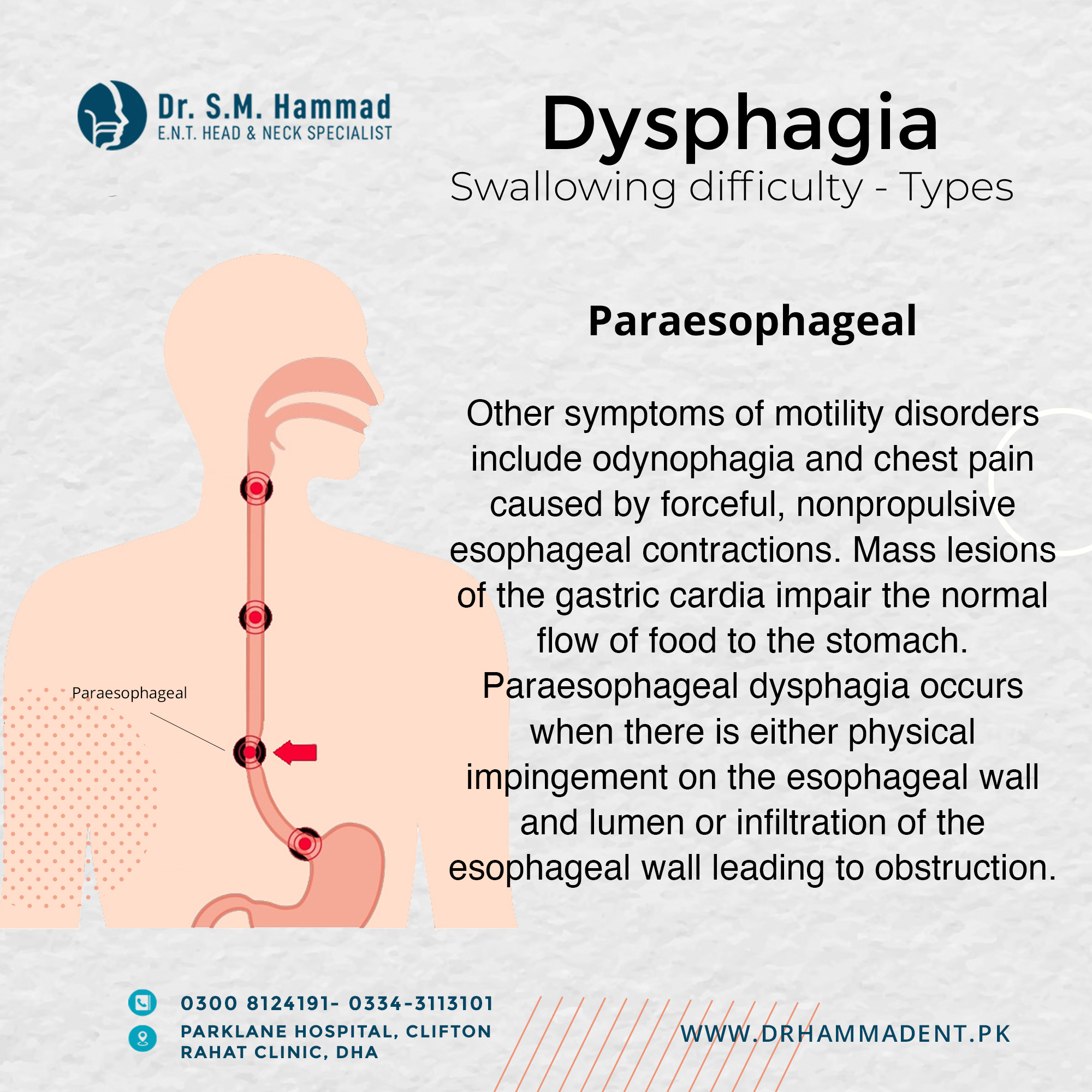Dr. - Paraesophageal dysphagia occurs when there is either physical ...