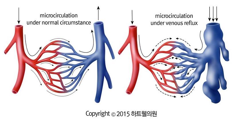 하지정맥류클리닉 하트웰의원 - 2015년의 그림과 2024년의 그림... 그 사이 정맥통증은 많이... | Facebook
