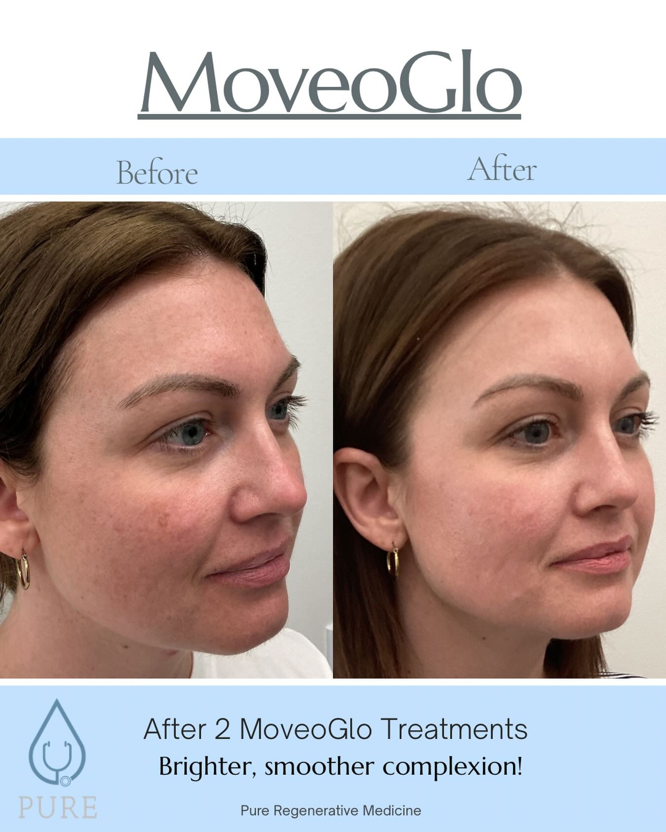 glutathione injection by sarah shah Holiday glow up ✓🙌. The MoveoGlo treatment is performed using our MotusAZ+ laser @motuslasers which delivers a pain free treatment with zero downtime!! Clients love their results-seeing improvements in skin tone GHK-CU (50mg) – JC كريم للوجه للتفتيح التدريجي Size:4-week supply
