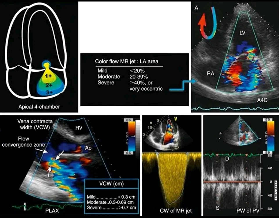 الدكتور - #️⃣ #Tricuspid_Regurgitation_Echo_Update (2025) Echo Criteria ...