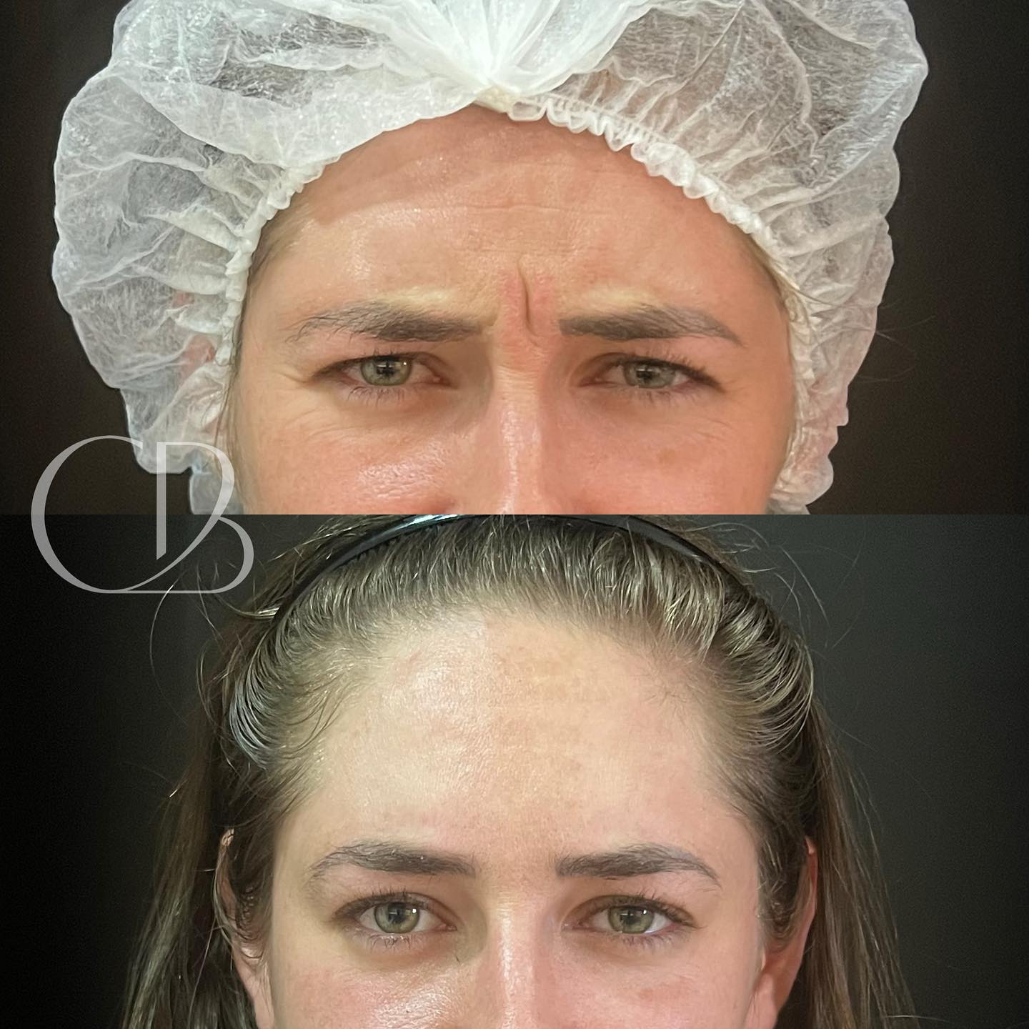 Botox na... - Clínica CB Harmonização Facial e Odontologia