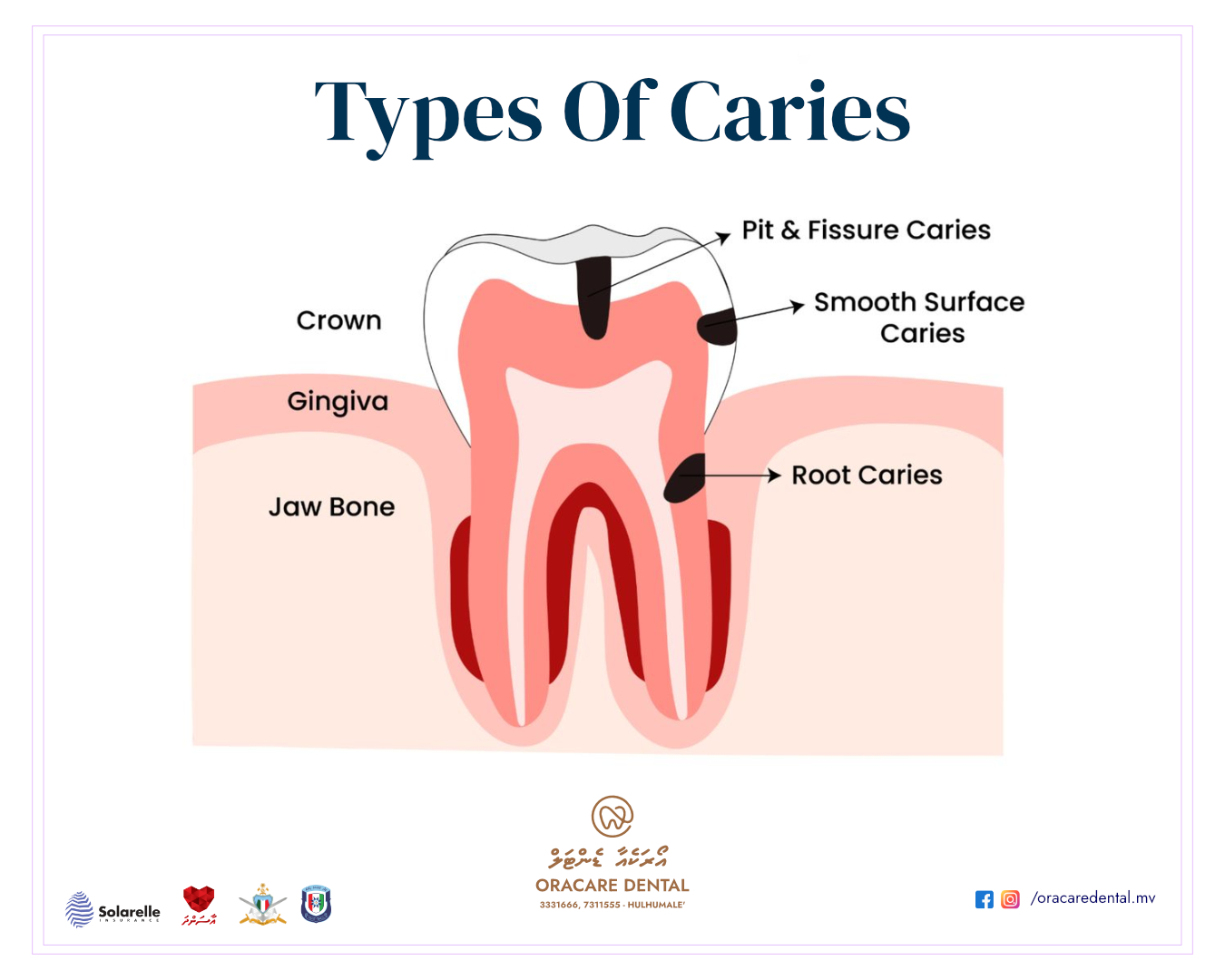 Oracare - 🦷 Did You Know? Cavities Can Form in Different Parts of a ...