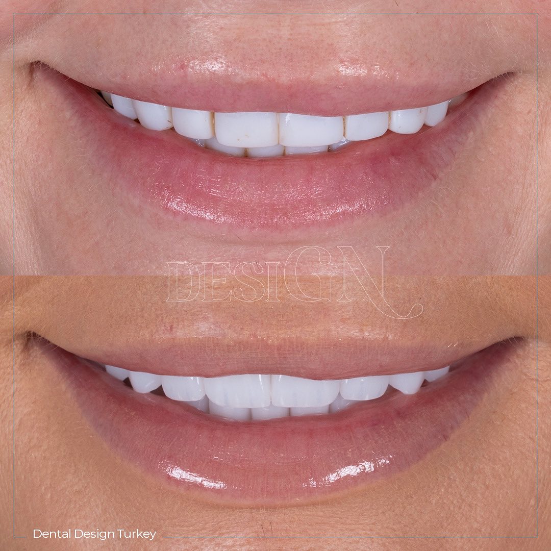 The common problem of dental... Dental Design Turkey