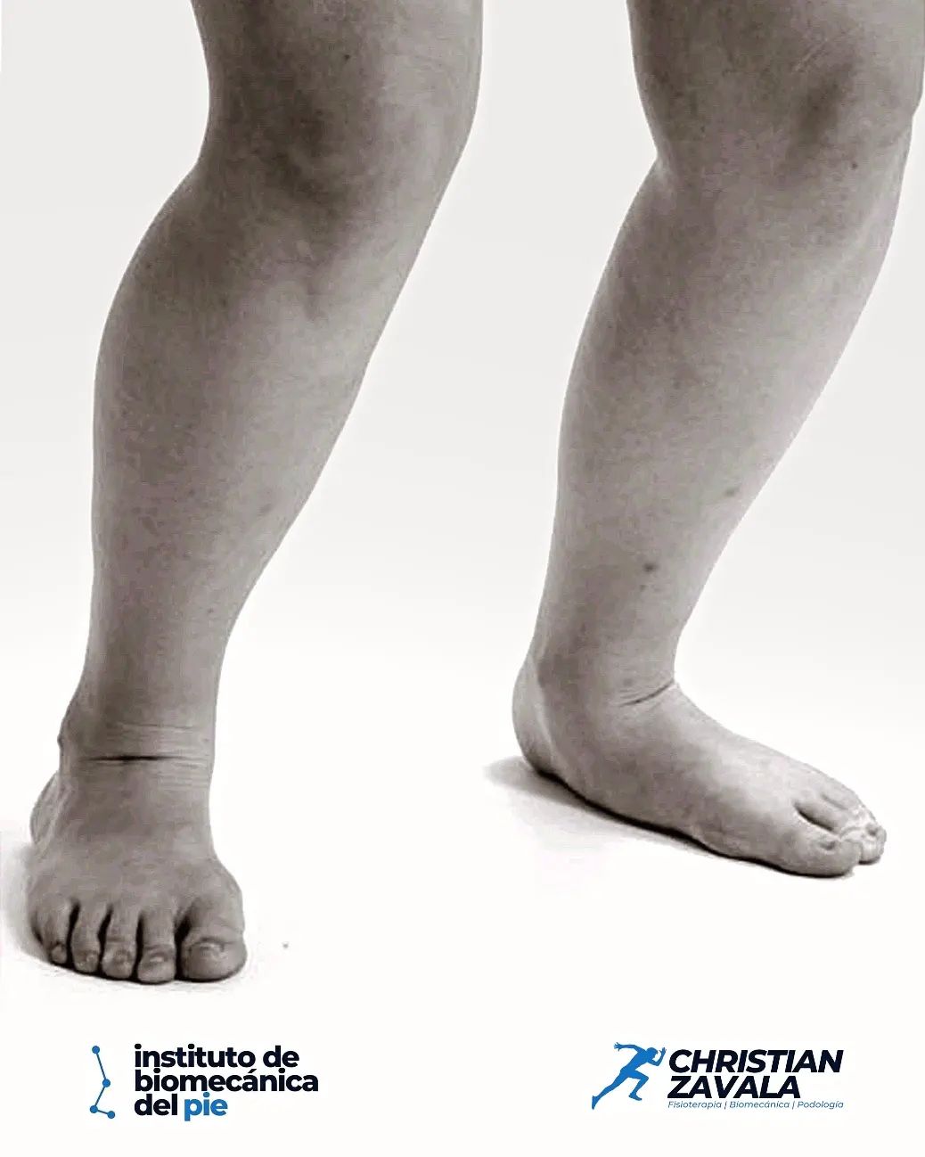 La articulación transversal del tarso... La articulación talonavicular ...