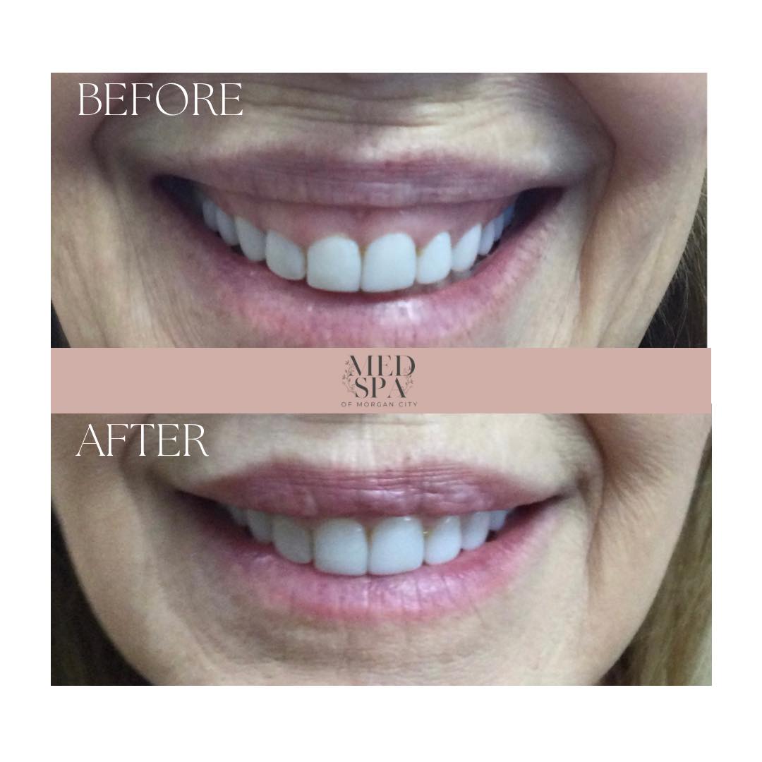 Did you know that Botox can be... - Med Spa of Morgan City | Facebook