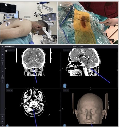 #ONSNew Full-Endoscopic... - Neurosurgery Publications