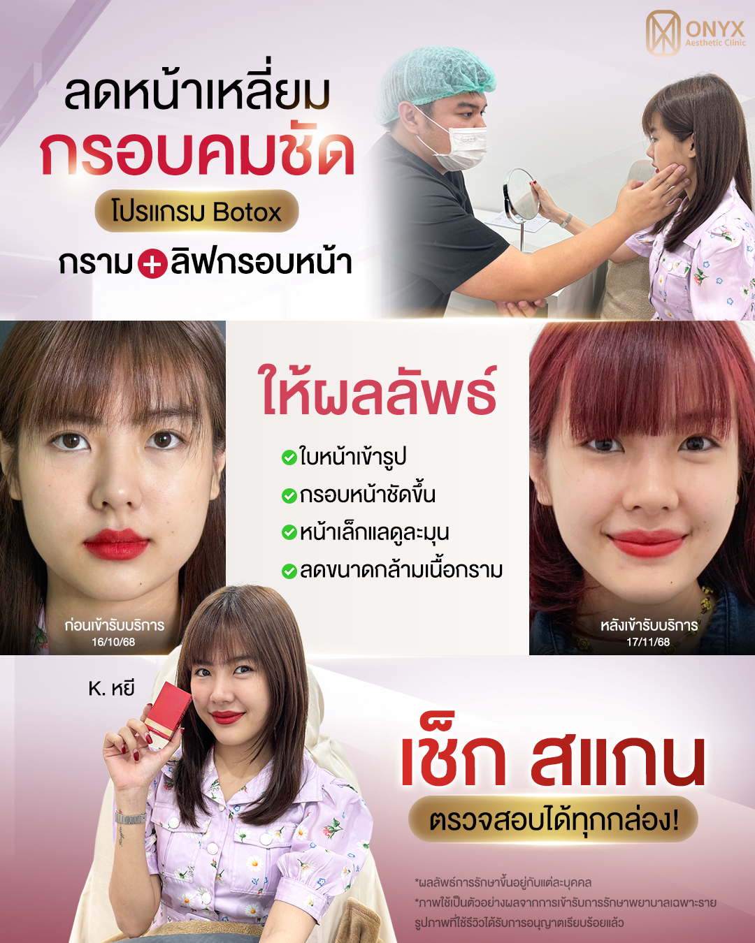 ลดหน้าเหลี่ยม กรอบคมชัด🧏🏼‍♀️💫 โปรแกรม Botox กราม + ลิฟกรอบหน้า ...