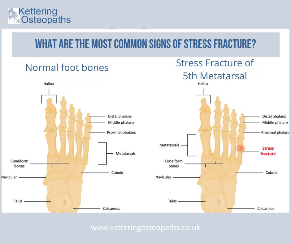 💙🤔What are the most common signs of... - Kettering Osteopaths | Facebook
