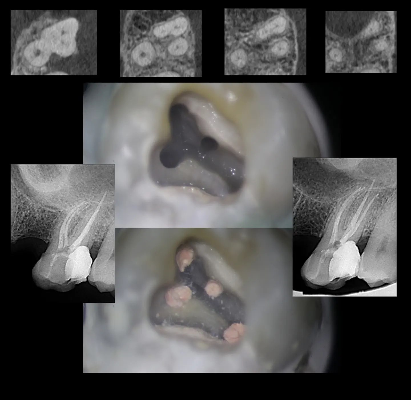 endodonc... - Mg. Esp. Andre Zevallos- Endodoncia Microscópica