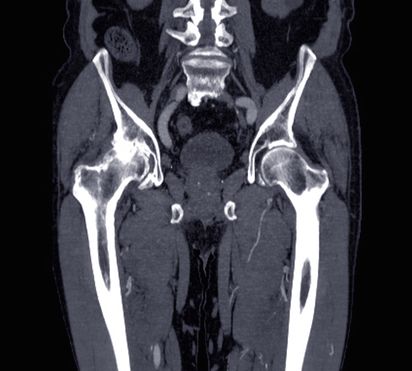 A hip CT scan performed... - Adirondack Radiology Associates