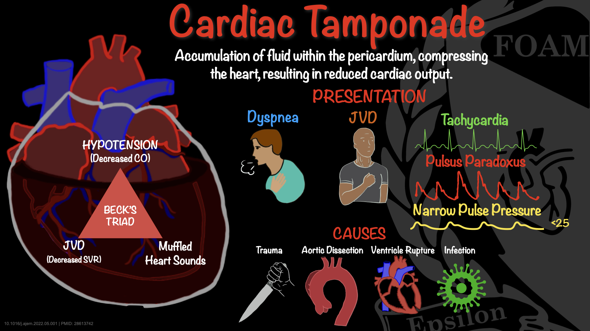FOAMfrat - In cardiac tamponade, fluid collects within the pericardium ...