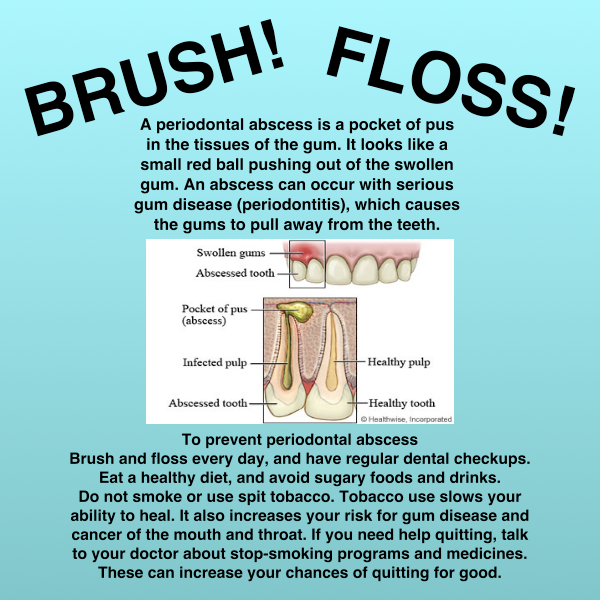 Faces & Braces - Bala Cynwyd - A periodontal abscess is a pocket of pus ...