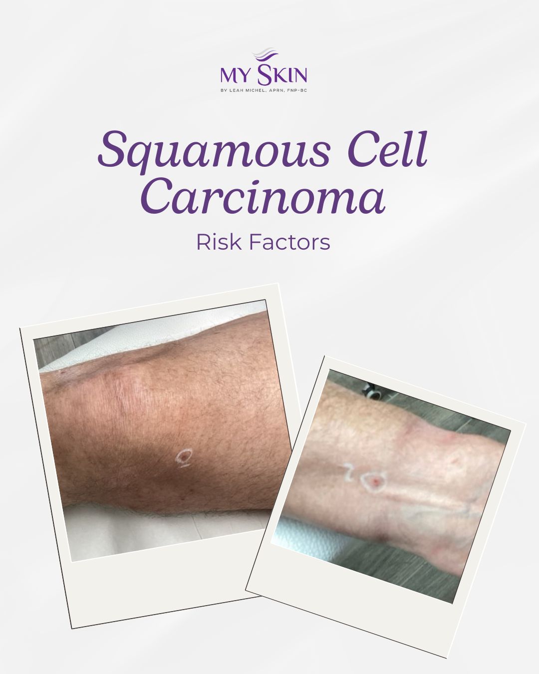 My - ⚠️ Let’s Talk About Squamous Cell Carcinoma (SCC) SCC is one of ...