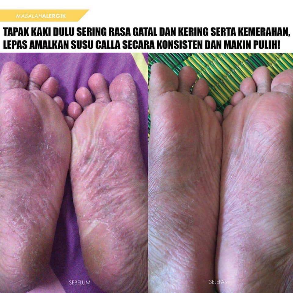Callabeauty Co Tapak Kaki Gatal Kering Kemerahan Facebook