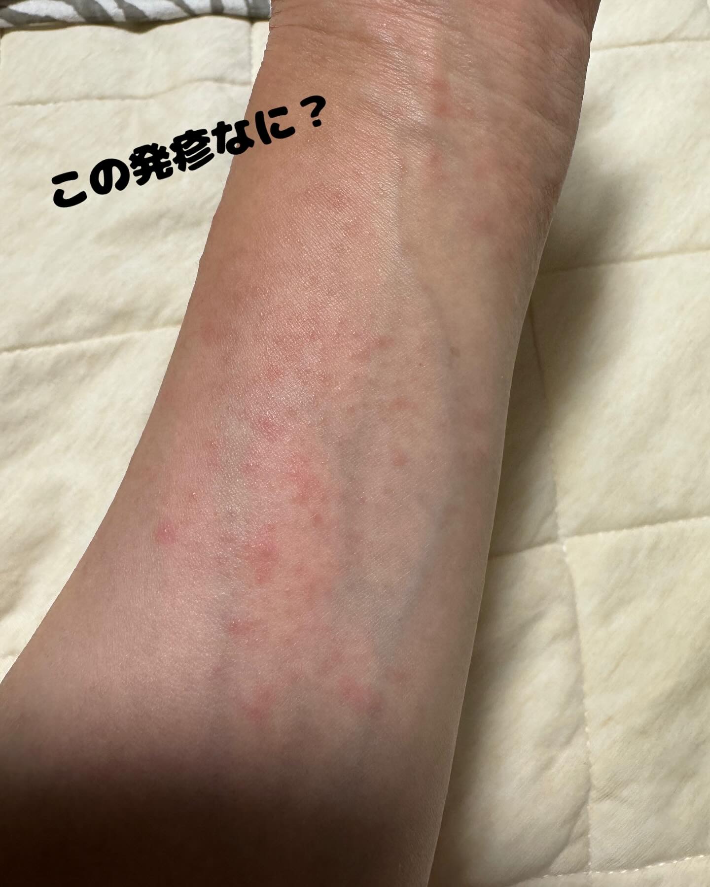 かゆみ の ない 発疹 写真