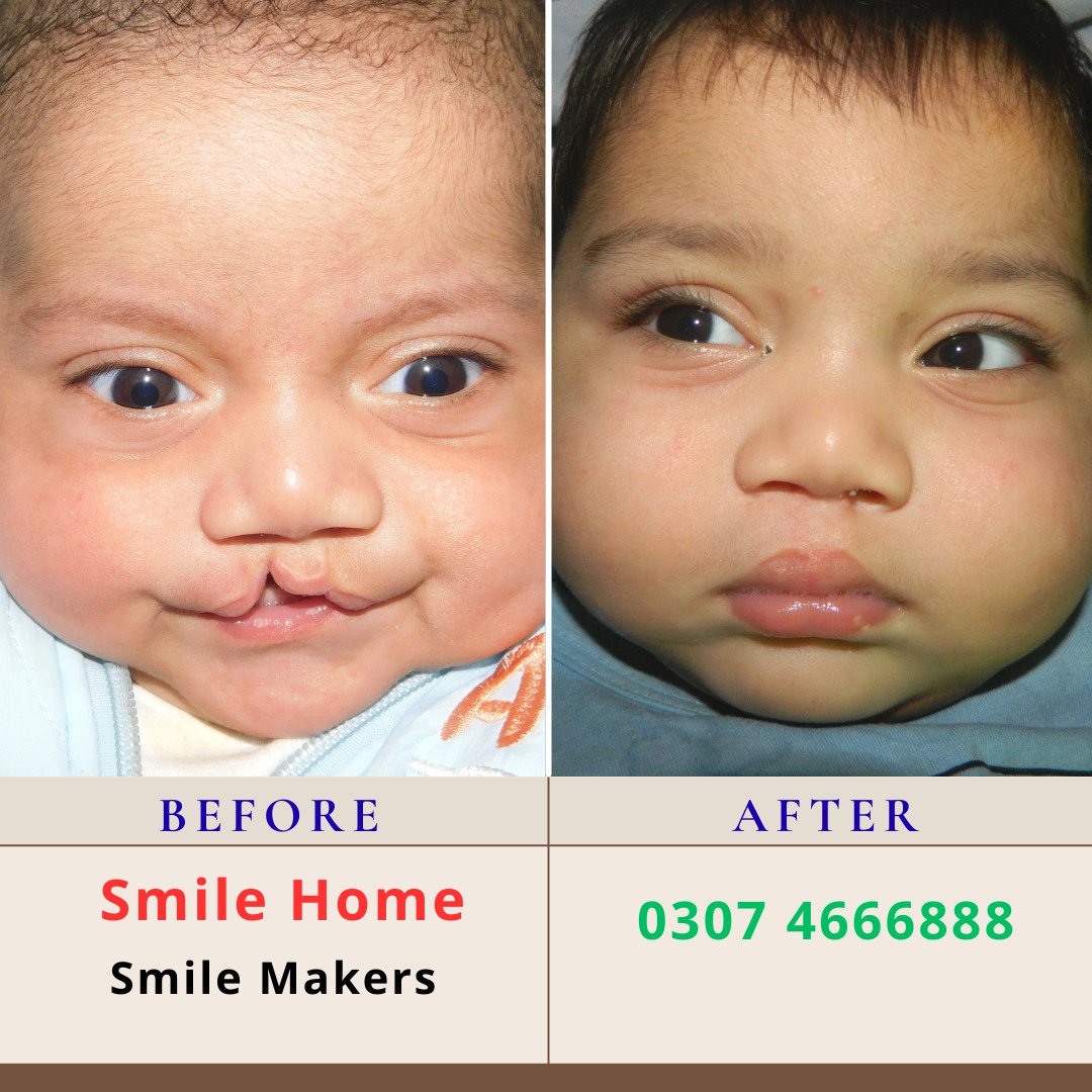 Smile - Free Cleft Lip and Cleft Palate Surgery In Lahore By Dr Irfan ...