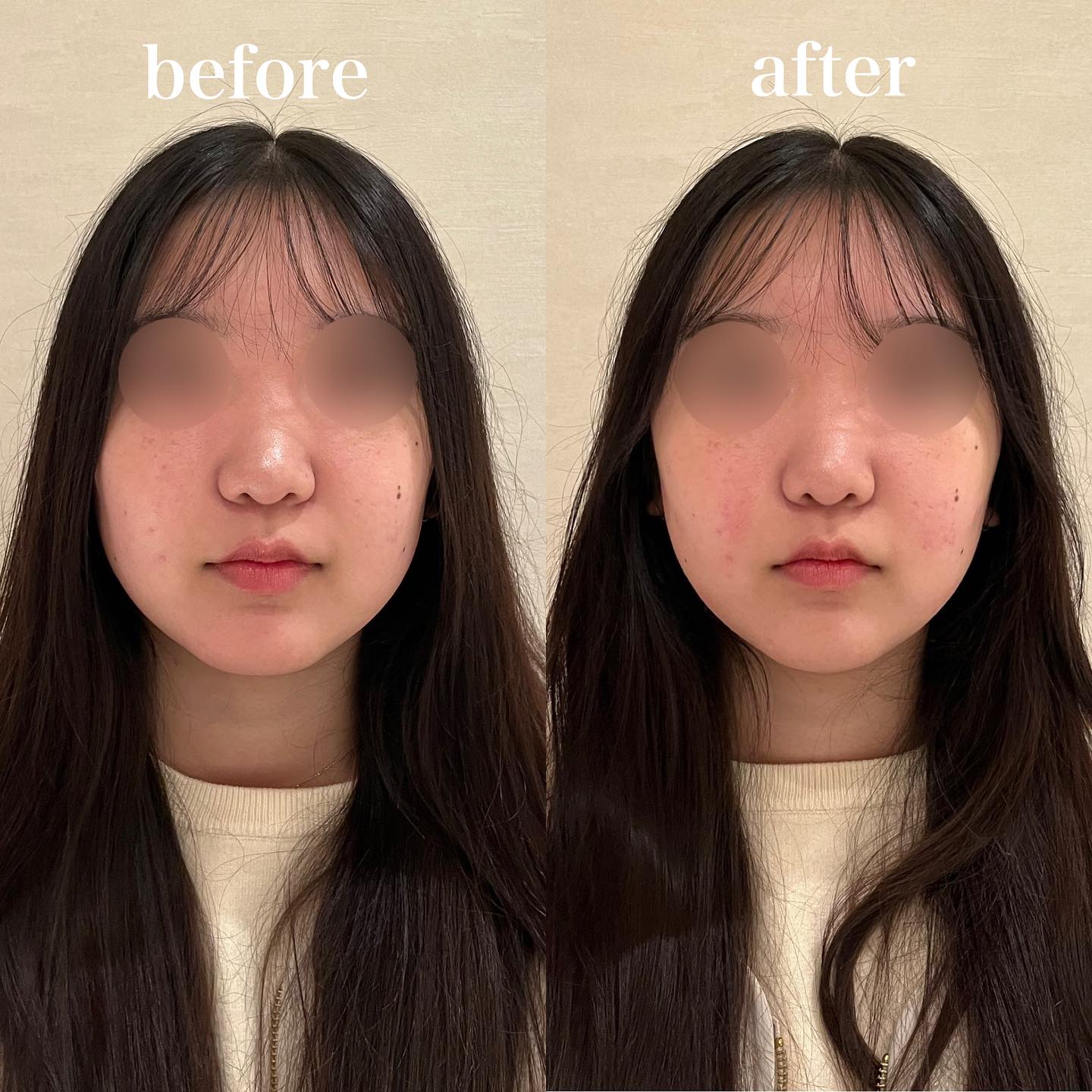 ハリノヒ大阪院 - 【顔のむくみを取りたい】 顔のむくみを成人式に向けて取りたいとハリノヒにお越しくださいました👘... | Facebook