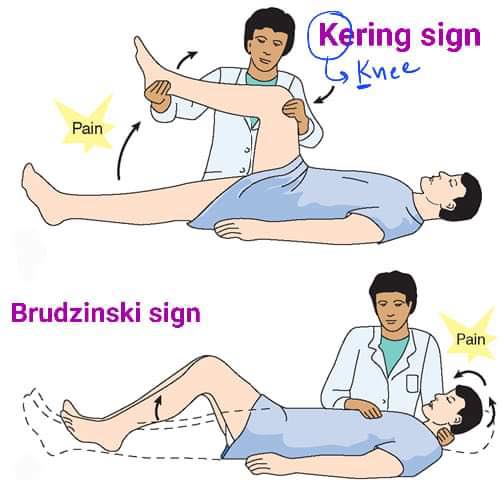 Vince - 1. Kernig's sign: Pain and resistance when extending the knee ...