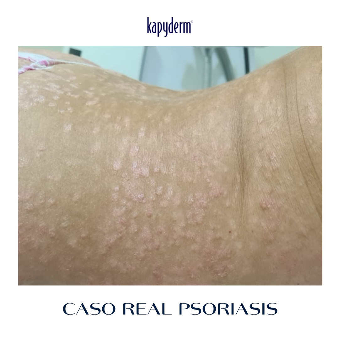 CASO REAL PSORIASIS CUERPO... - Laboratorios Kapyderm