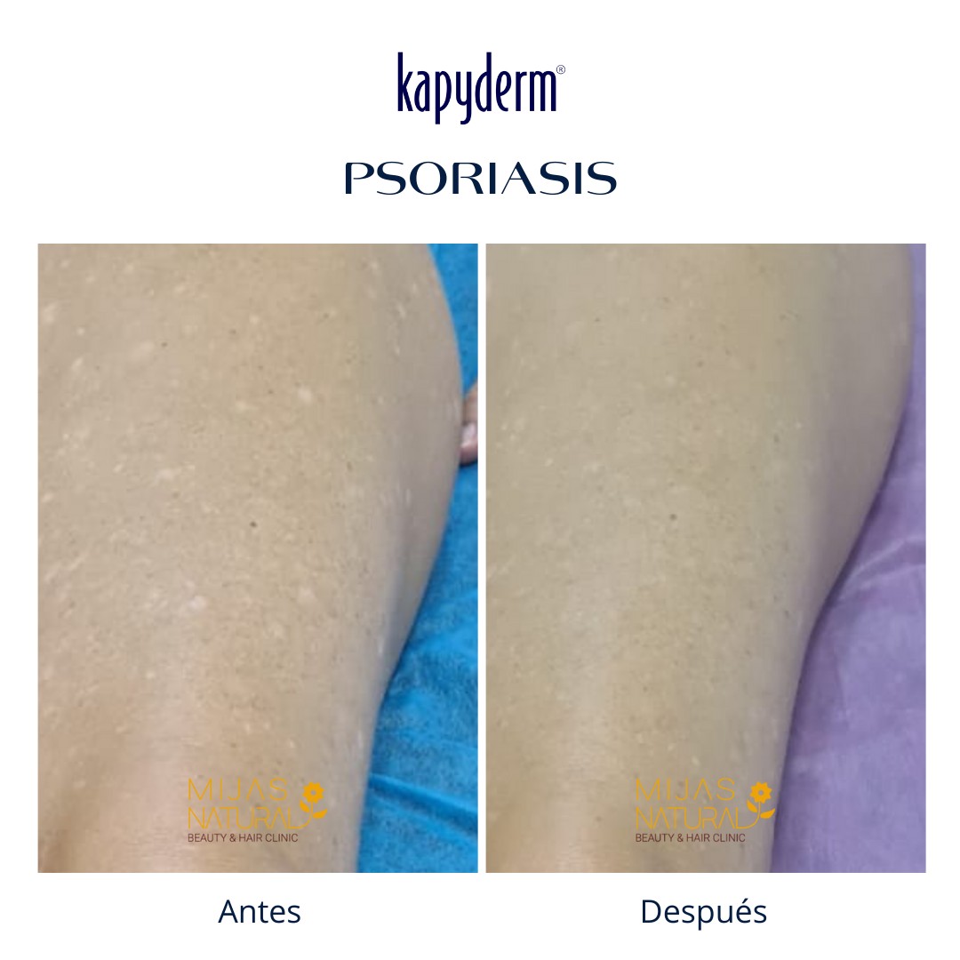 CASO REAL PSORIASIS CUERPO... - Laboratorios Kapyderm