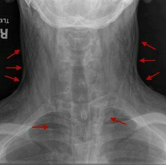 MedicTests.com - Subcutaneous emphysema is a condition in... | Facebook