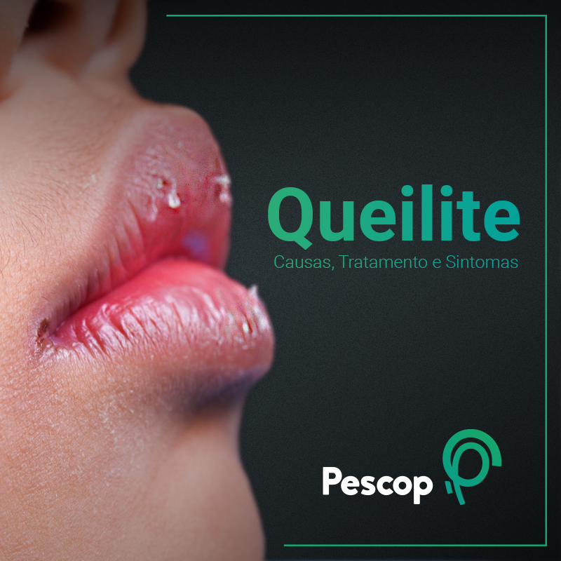 Pescop - A queilite é uma inflamação nos lábios que se apresenta quase ...