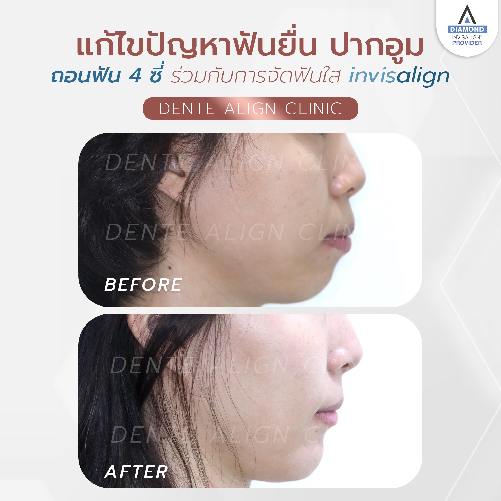 ฟันยื่น... - Dente Align Clinic - Invisalign Diamond Provider