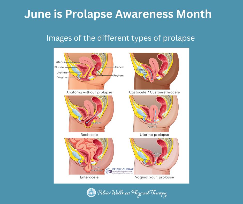 Pelvic - 🌼 June is Prolapse Awareness Month! 🌼 Pelvic organ prolapse ...