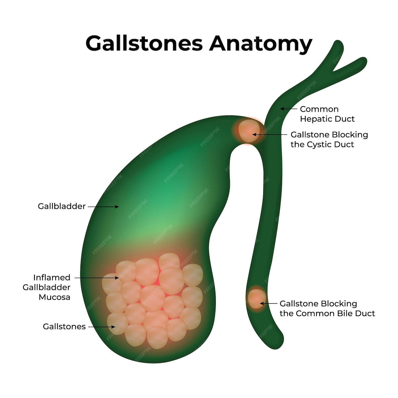 glutathione gallstones Gallstones: Treatments, symptoms, and causes Your liver and gallbladder explained