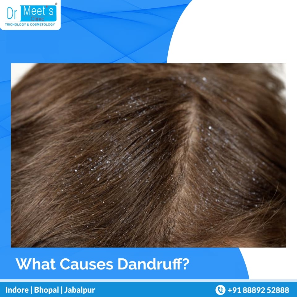 Oil from the scalp causes the... - Dr Meet's Clinic Jabalpur | Facebook