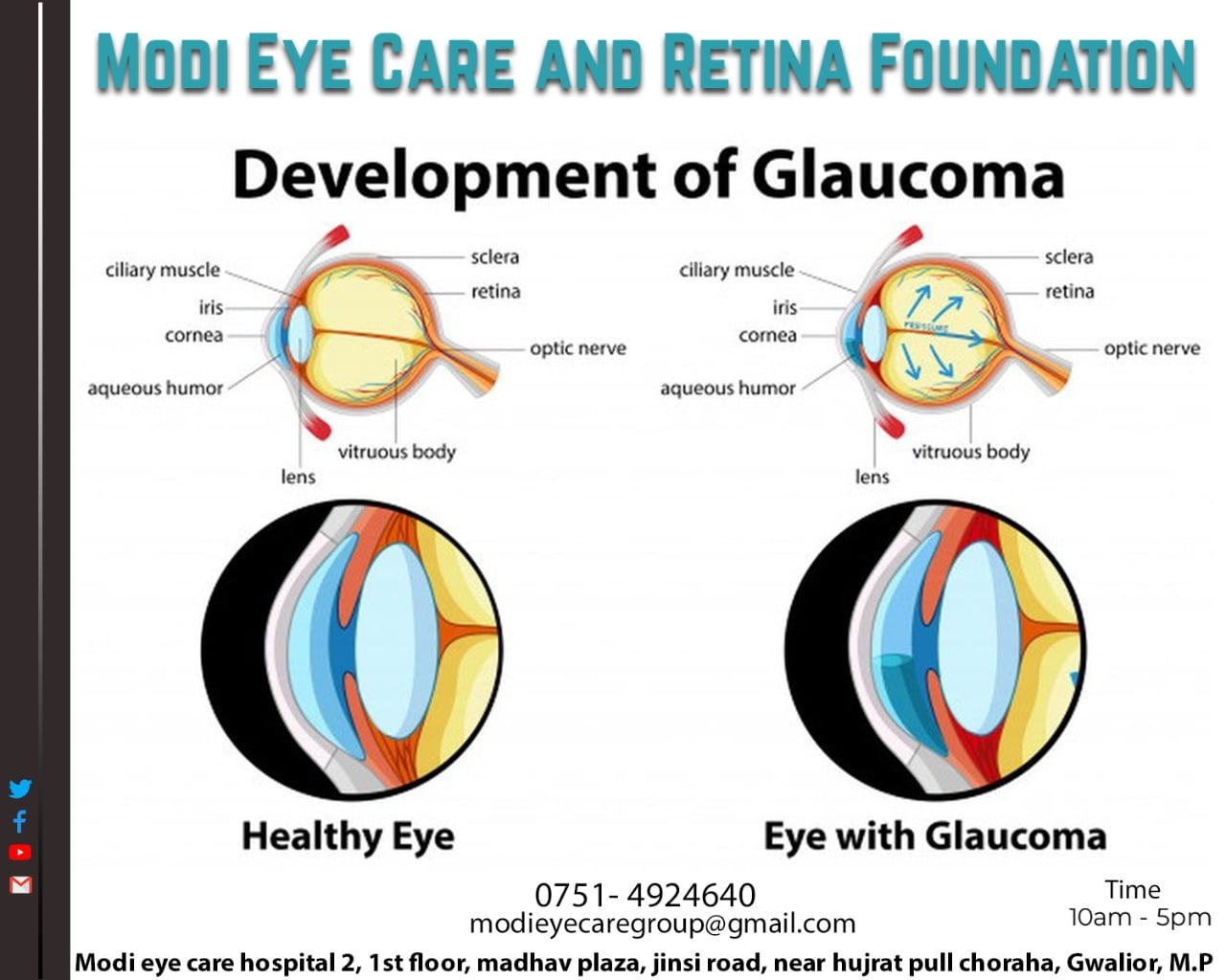 The most common type of... - Modi eye care group of hospitals