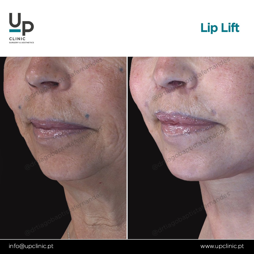 UP Clinic - Caso clínico Lip lift ou lifting labial para... | Facebook
