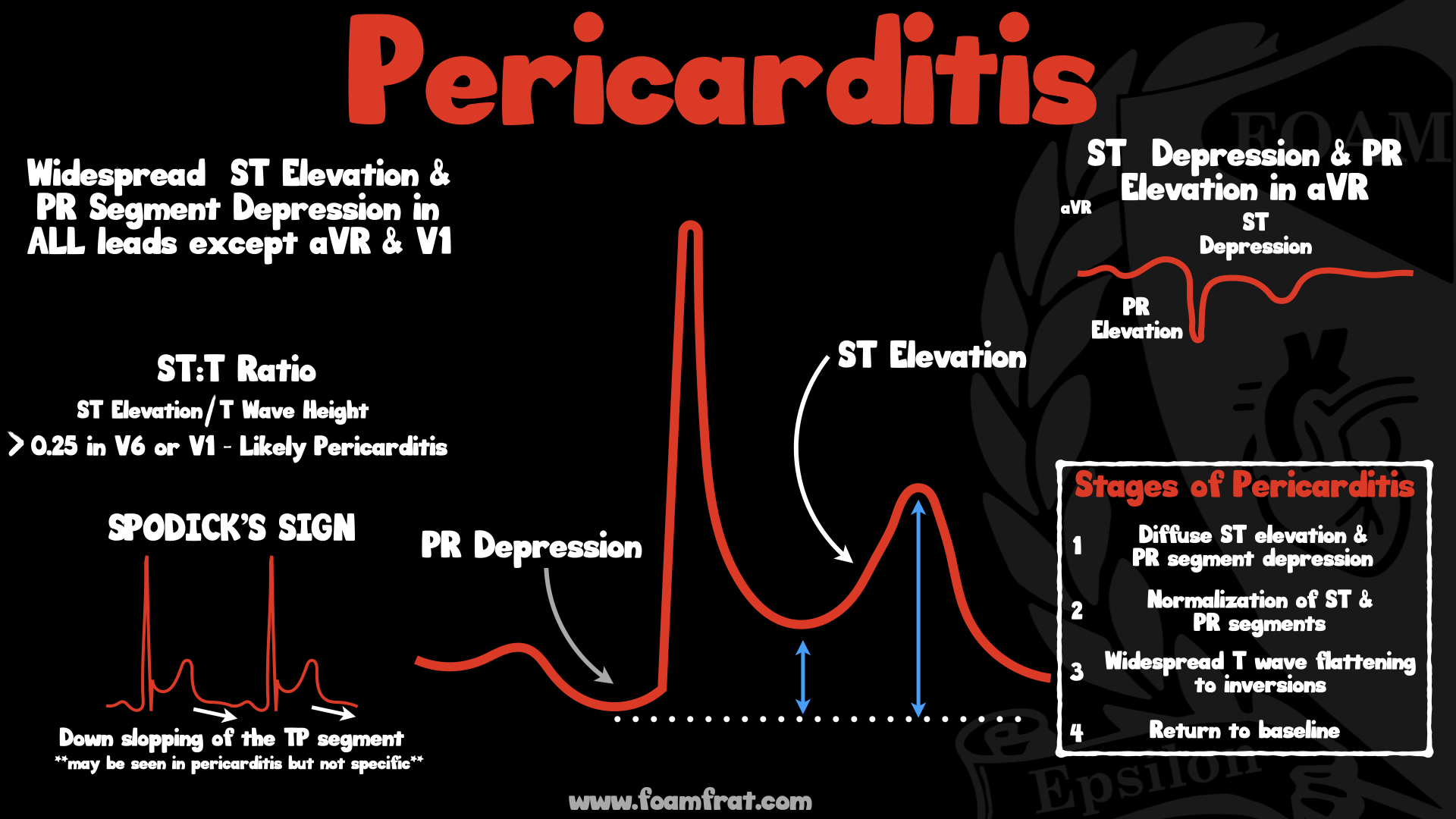 FOAMfrat - EKG findings associated with Pericarditis | Facebook