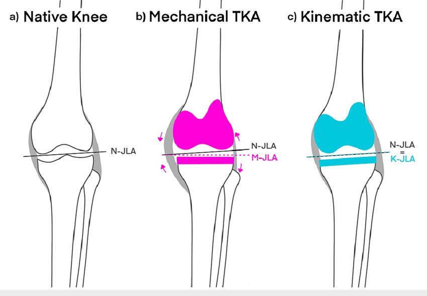 Ortho-Pics - TKA Alignment Update: KA vs. AA 🦵🔄 We're... | Facebook
