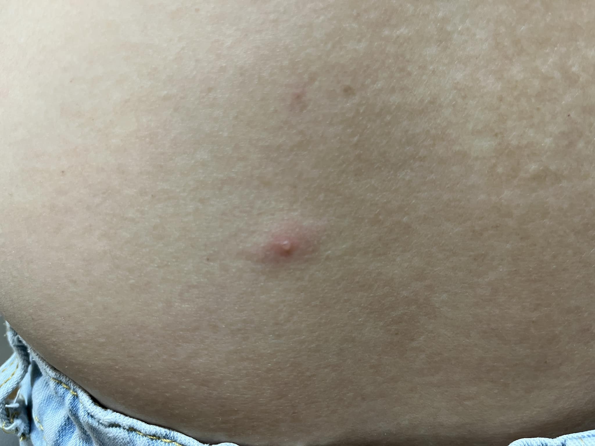 行心堂中醫診所 - 《水痘不是小孩的專利🫨》 👩🏻：醫師，我最近唔知係咪食左好多曳嘢，生左好多疹，想比你睇下 🧑🏻‍⚕️：嗯，啲疹幾時開始有㗎 ...