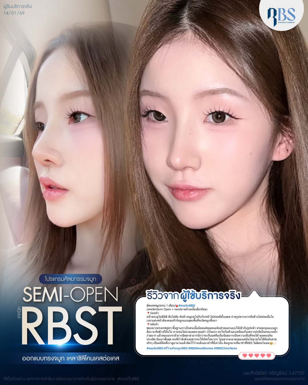 RBS Clinic - เคสที่คนถามเข้ามาเยอะมากกกก !!... | Facebook