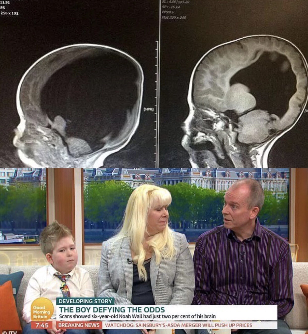history-in-2012-noah-wall-was-born-with-only-2-of-his-brain-along