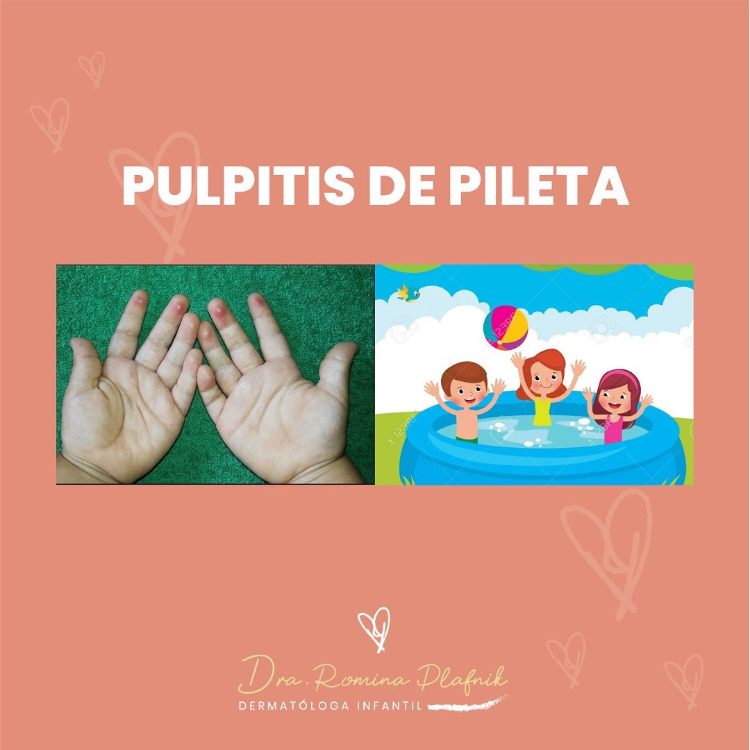 Romina - 🐙Púlpitis de pileta, o Pool palms. El pulpo no tiene la culpa ...
