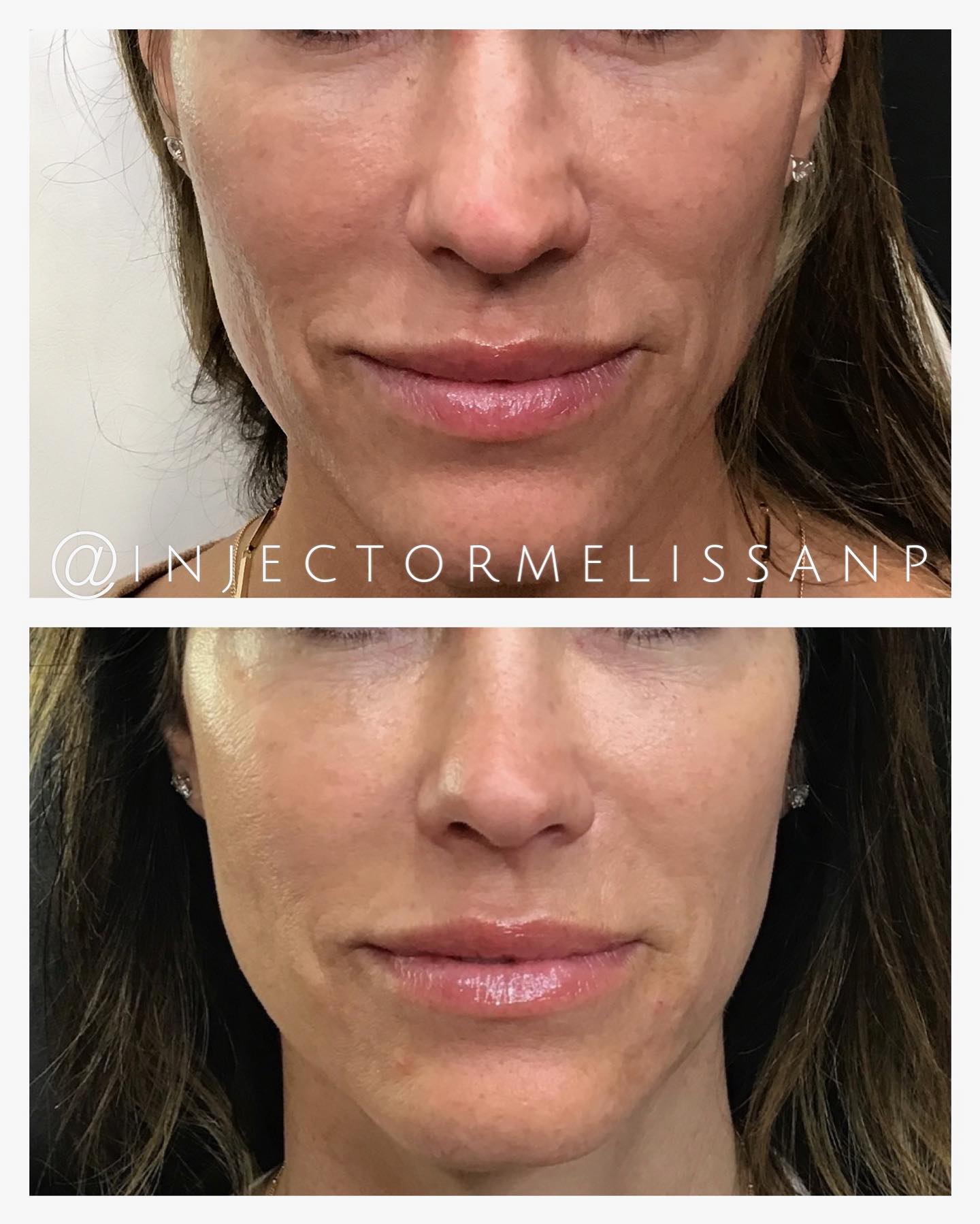 𝗧𝗵𝗲 𝗳𝘂𝘁𝘂𝗿𝗲 𝗼𝗳 𝗿𝗲𝗴𝗲𝗻𝗲𝗿𝗮𝘁𝗶𝘃𝗲 𝗮𝗲𝘀𝘁𝗵𝗲𝘁𝗶𝗰𝘀 𝗶𝘀 𝗵𝗲𝗿𝗲. ✨ Lipoderma is changing the way we think about facial rejuvenation. Instead of simply adding volume, it's designed to help restore the healthy fat lost