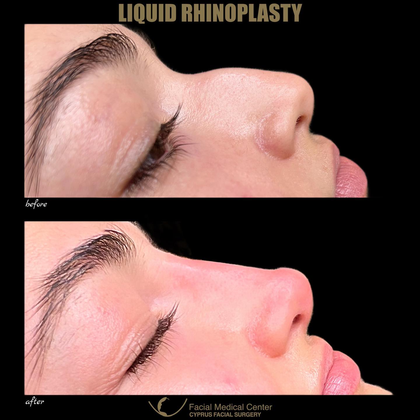 Transform your profile with... - Cyprus Facial Surgery