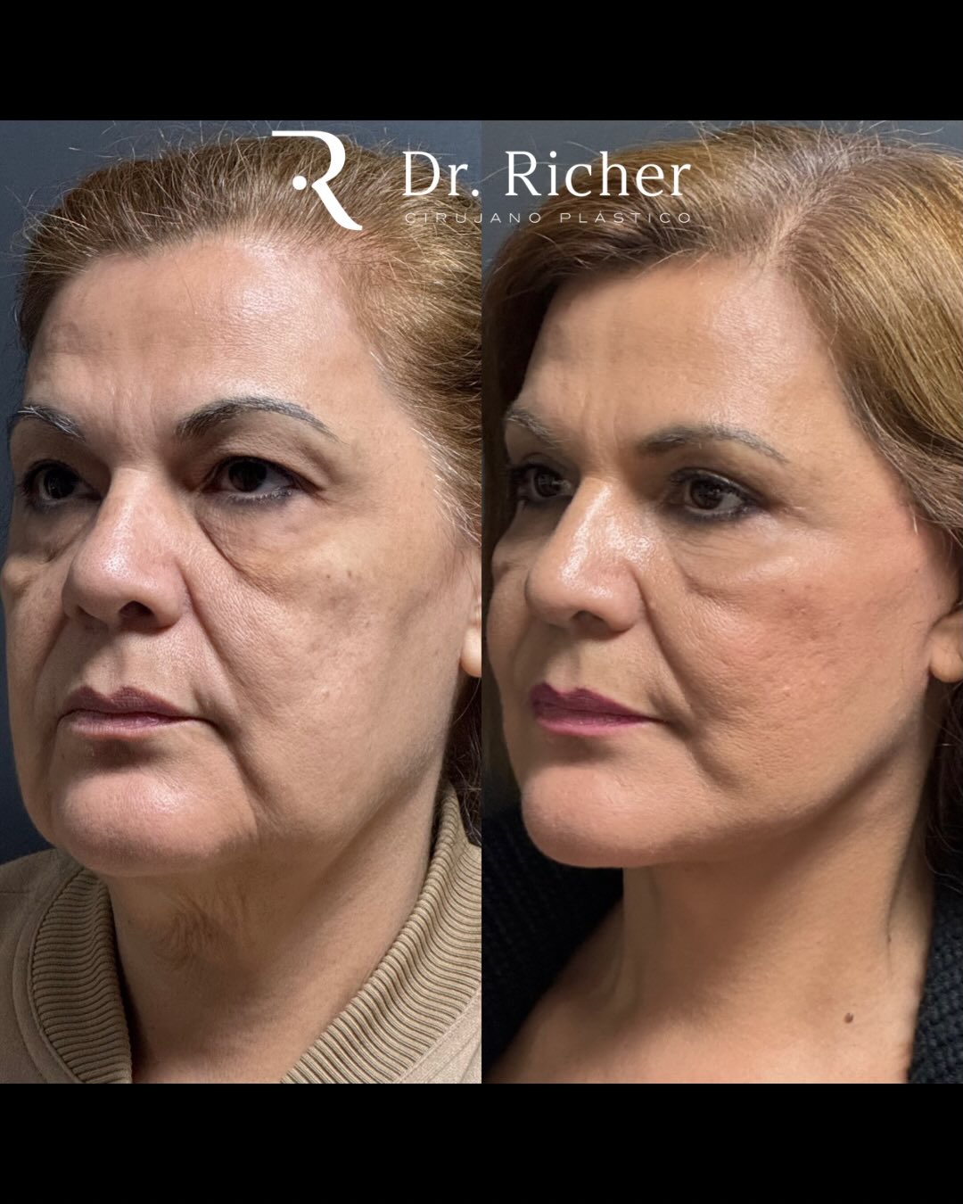 Dr. Richer Cirujano Plástico | San Pedro Garza Garcia