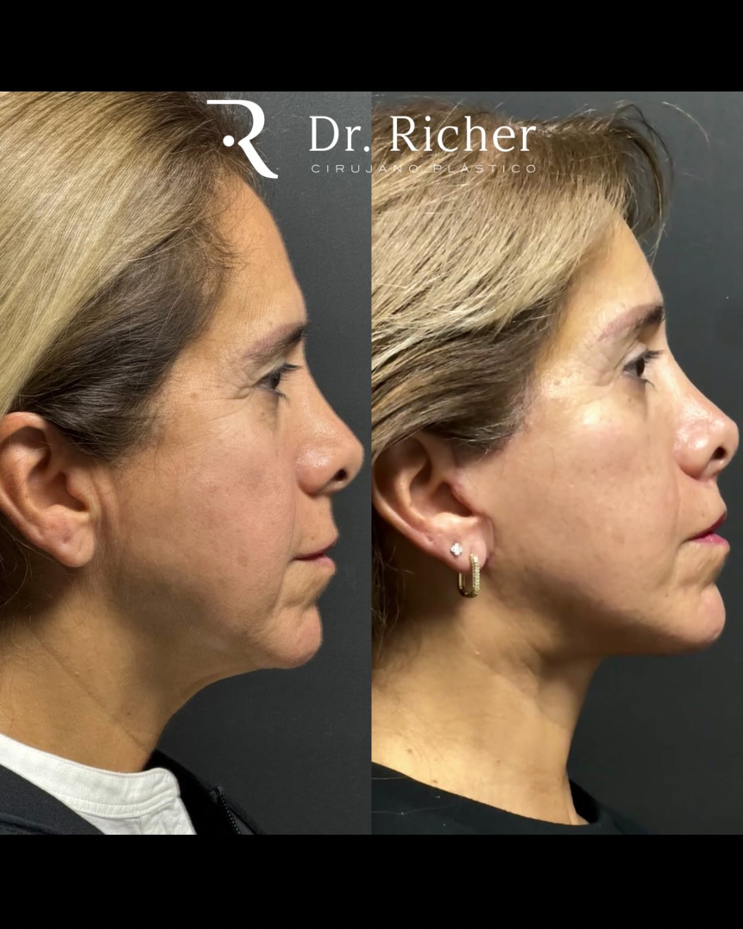 Dr. Richer Cirujano Plástico | San Pedro Garza Garcia