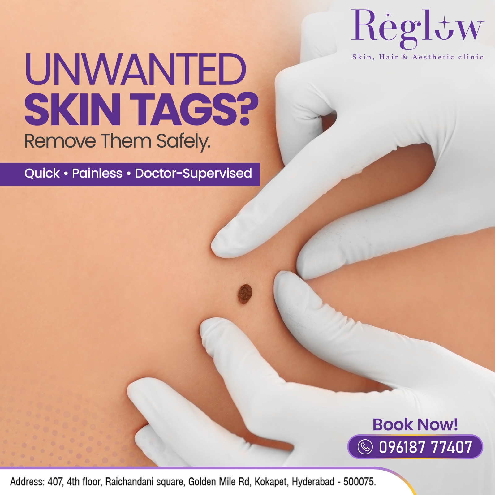 Reglow - Unwanted Skin Tags? We’ve Got You Covered! Skin tags may be ...