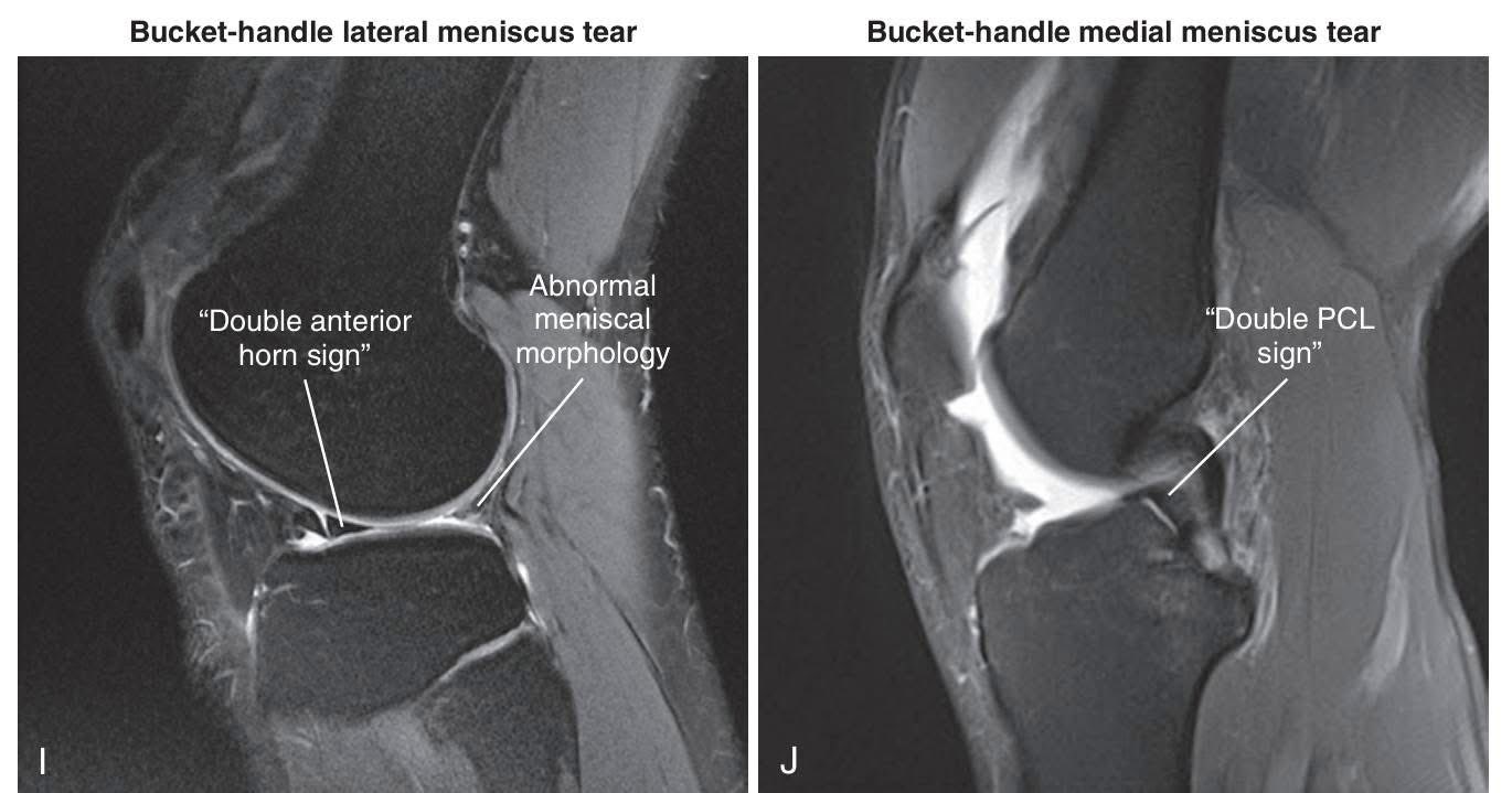 Ortho-Pics - Paediatric Elbow X-rays made easy – remember CRITOE! The ...