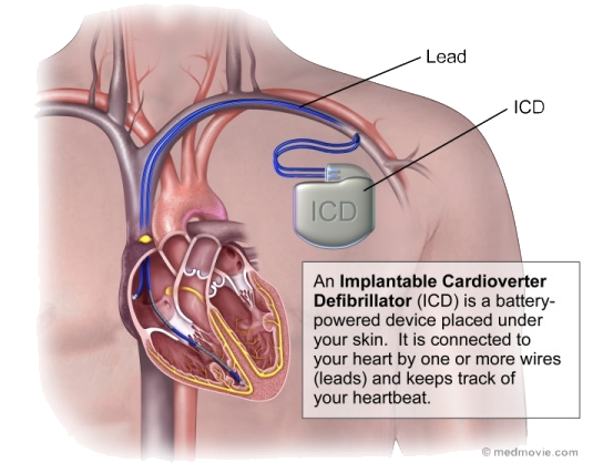 An implantable cardioverter-defibrillator (ICD) or automated ...