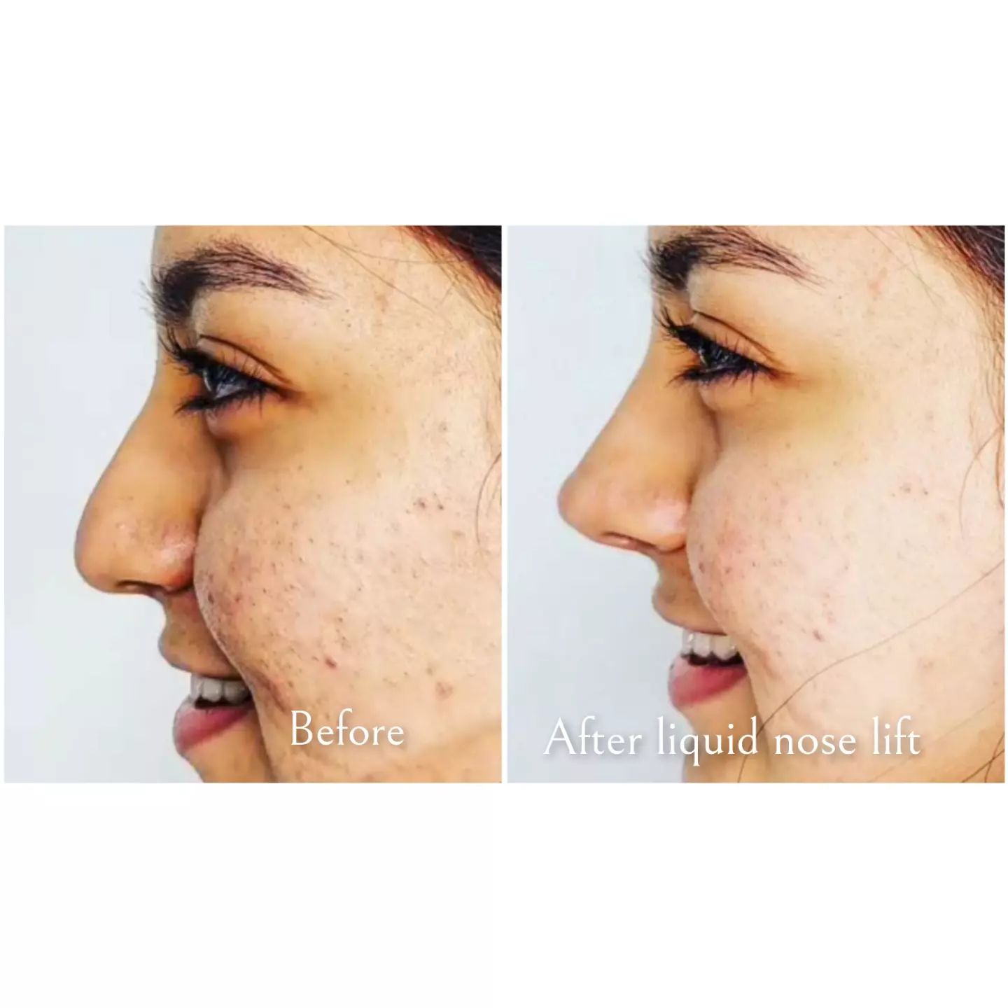 #liquidrhinoplasty... - Rejuvimed Advanced Medical Aesthetics